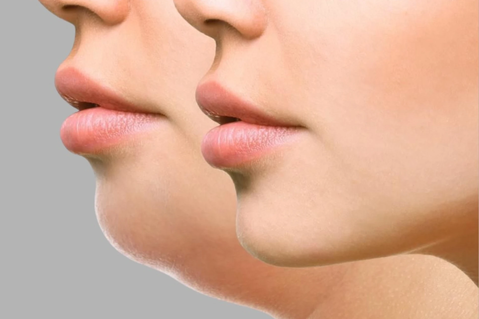 Zašto je podbradak postao najutjecajniji detalj ljepote lica i kako ga napredna estetika rješava bez noža?