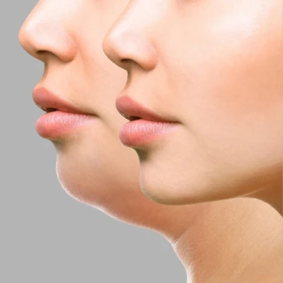 Zašto je podbradak postao najutjecajniji detalj ljepote lica i kako ga napredna estetika rješava bez noža?