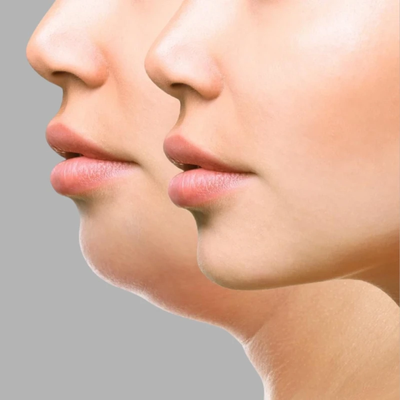 Zašto je podbradak postao najutjecajniji detalj ljepote lica i kako ga napredna estetika rješava bez noža?